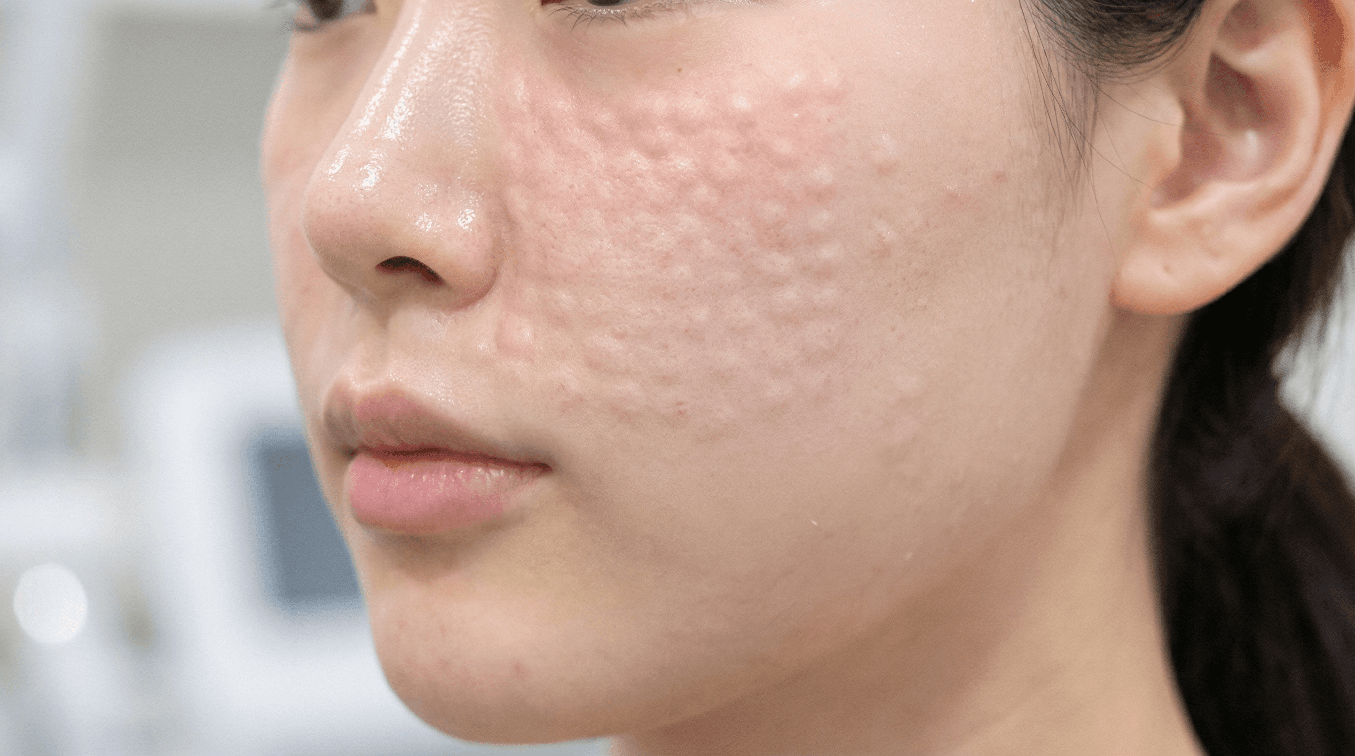 麗珠蘭Rejuran黑盒白盒紅盒韓國注射劑型比較