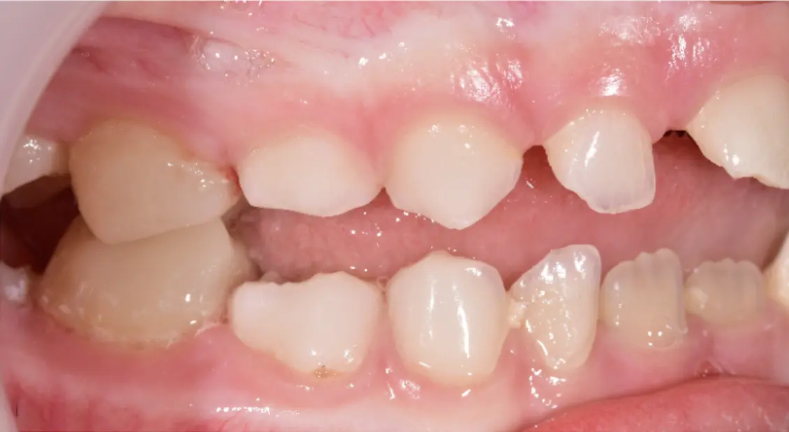 Right after the overlays cementation