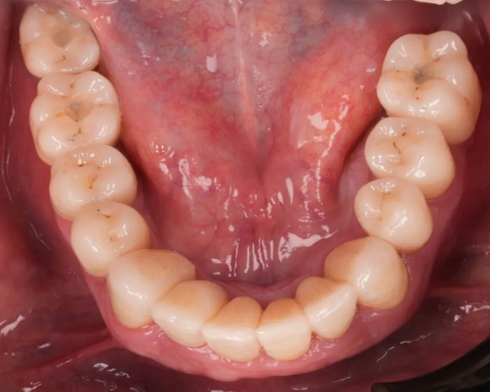 After prosthetic rehabilitation