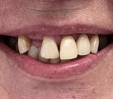 All-on-X implants - Full mouth restoration