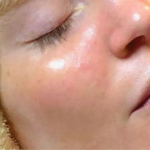 After HydraFacial MD at The Vancouver Aesthetician — skin visibly brighter, pores minimised, and complexion smooth and glowing