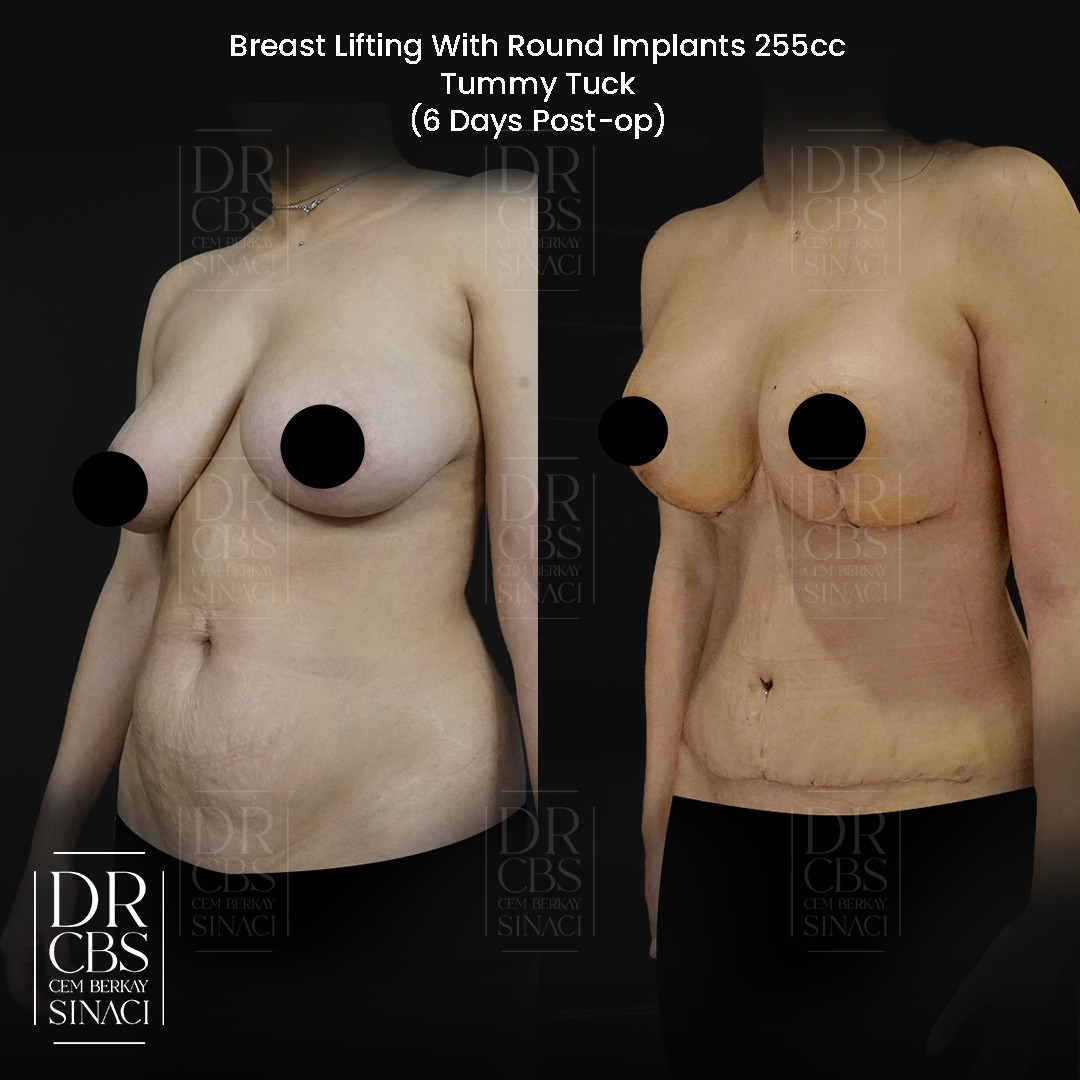 breast uplift with implant and abdominoplasty tummy tuck before after oblique view