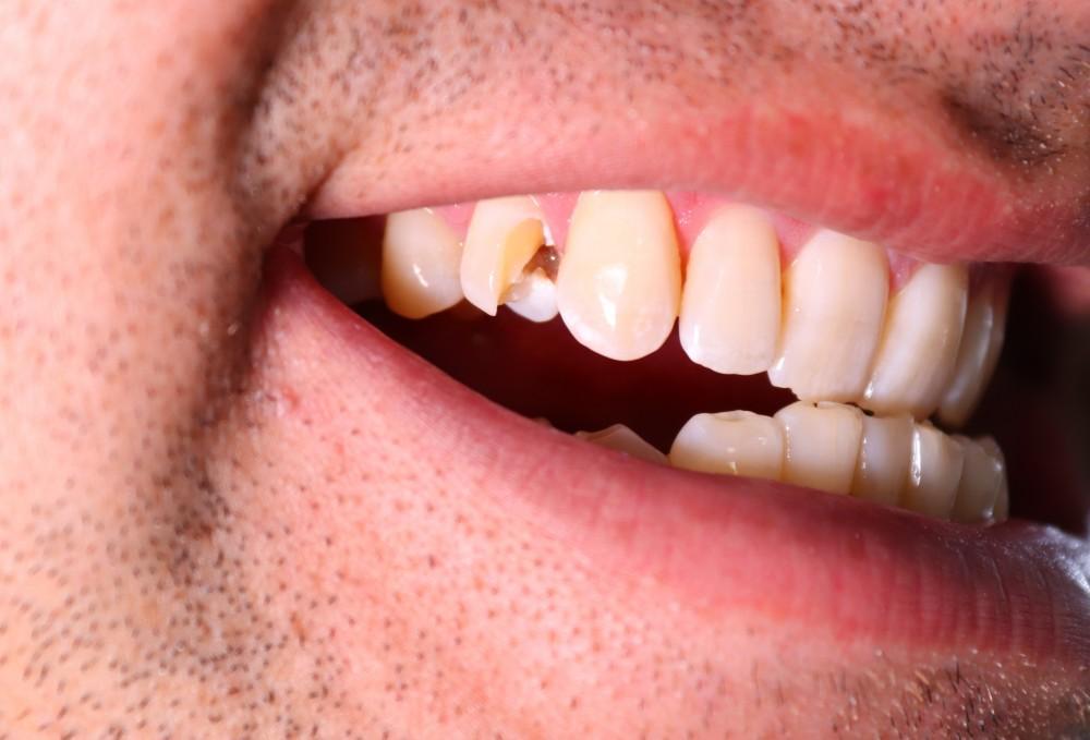 fractured tooth