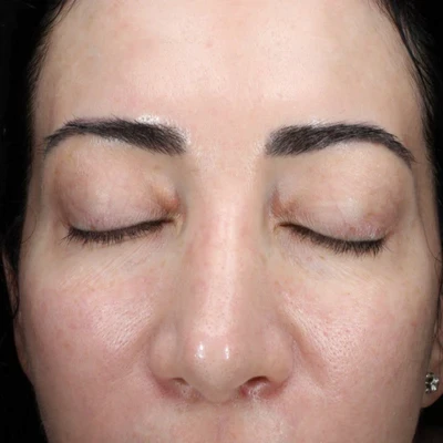 After soothing anti-inflammatory treatment at The Vancouver Aesthetician — skin tone visibly corrected and complexion noticeably more balanced and uniform