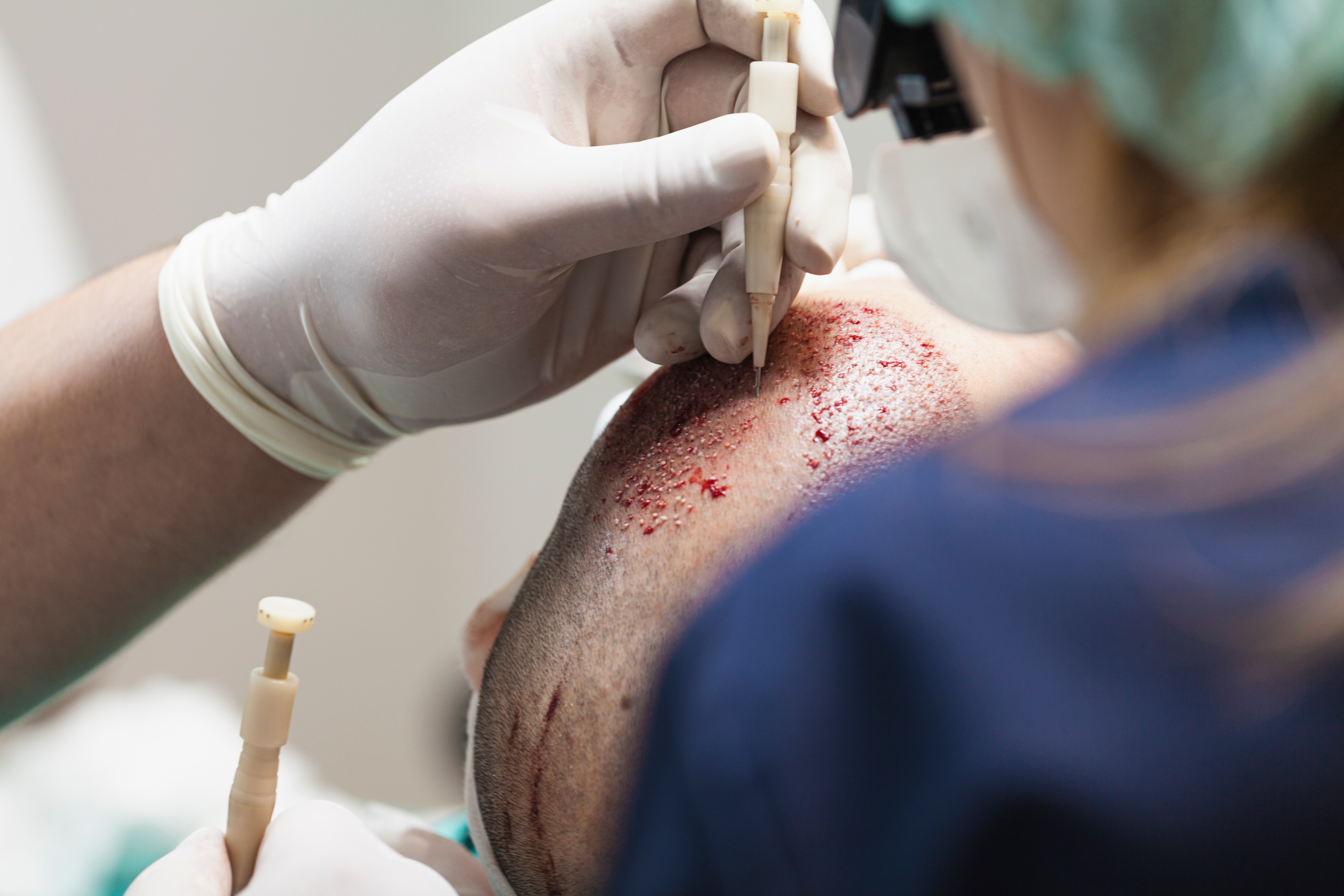Wondering if a hair transplant is your only option? Learn who benefits from hair transplantation, when it's appropriate, and why many people achieve excellent results without surgery.