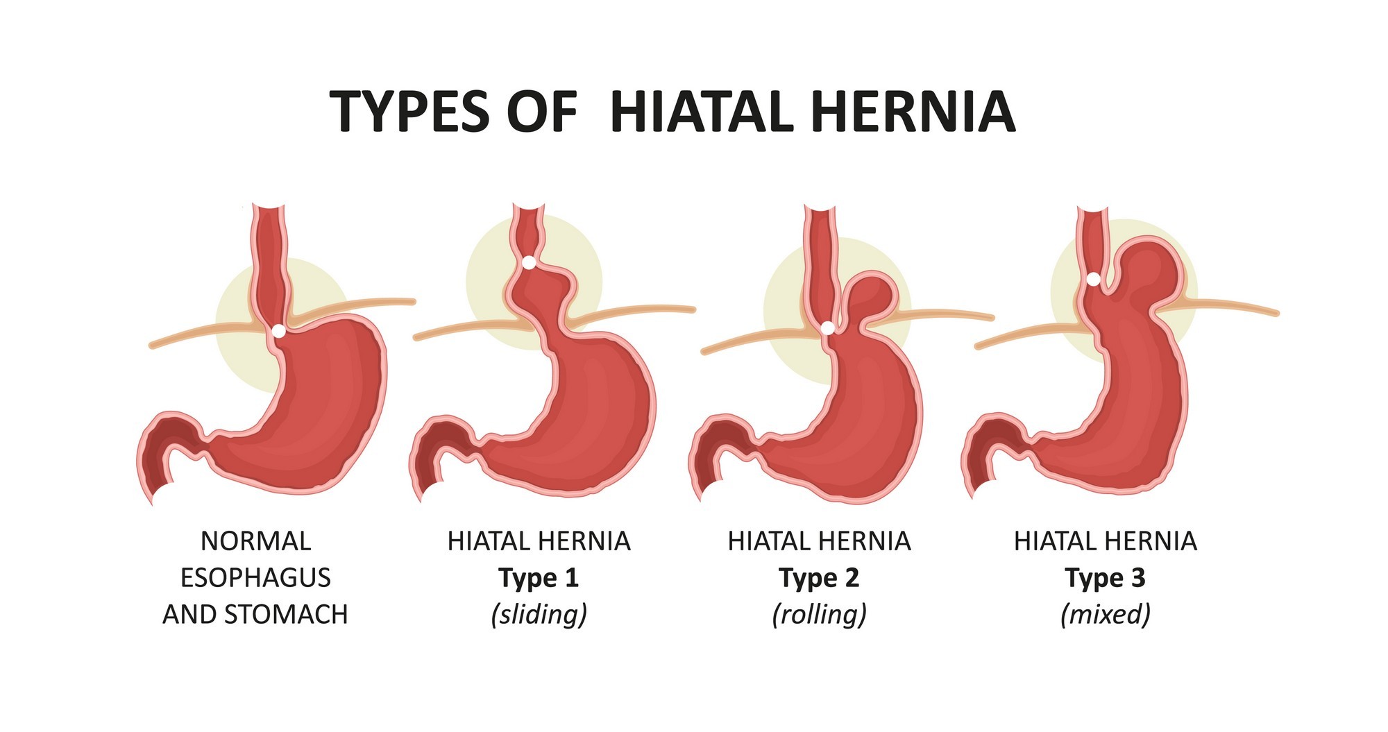 Types of Hiatus Hernia