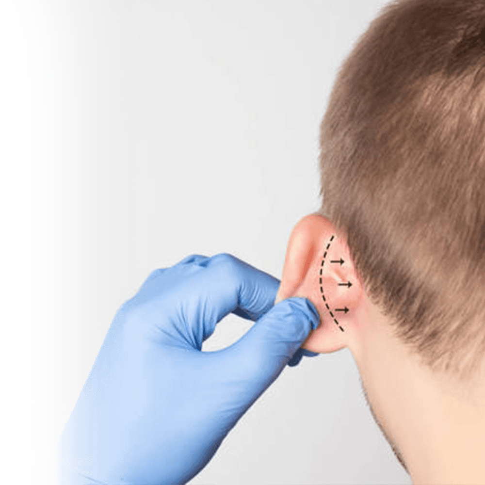 incision placement for prominent ear otoplasty surgery