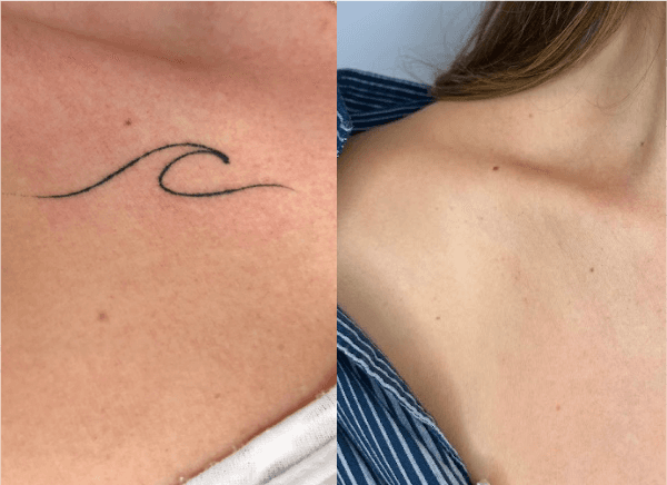 Imagem de antes e depois da remoção de tatuagem