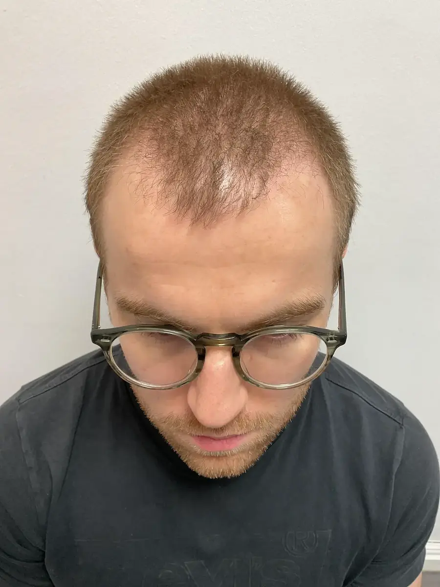Before hair transplant – Lewis's FUE Hair Transplant Result