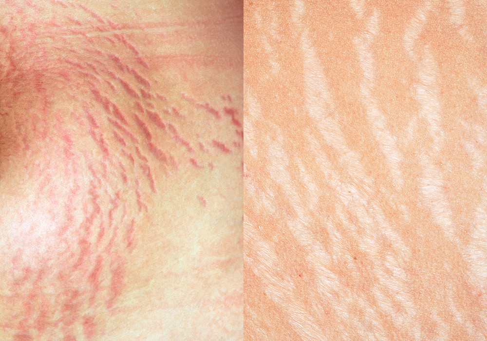 Types of stretch marks on the skin