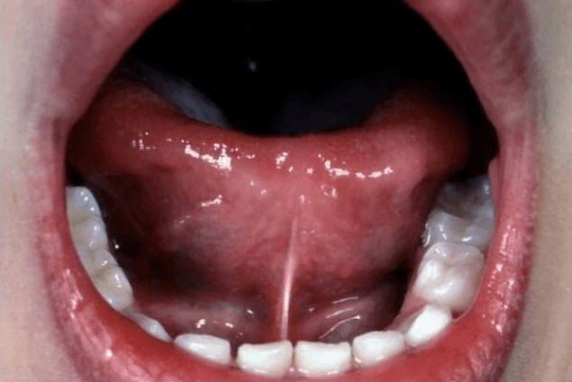 Frenillo anteriorizado