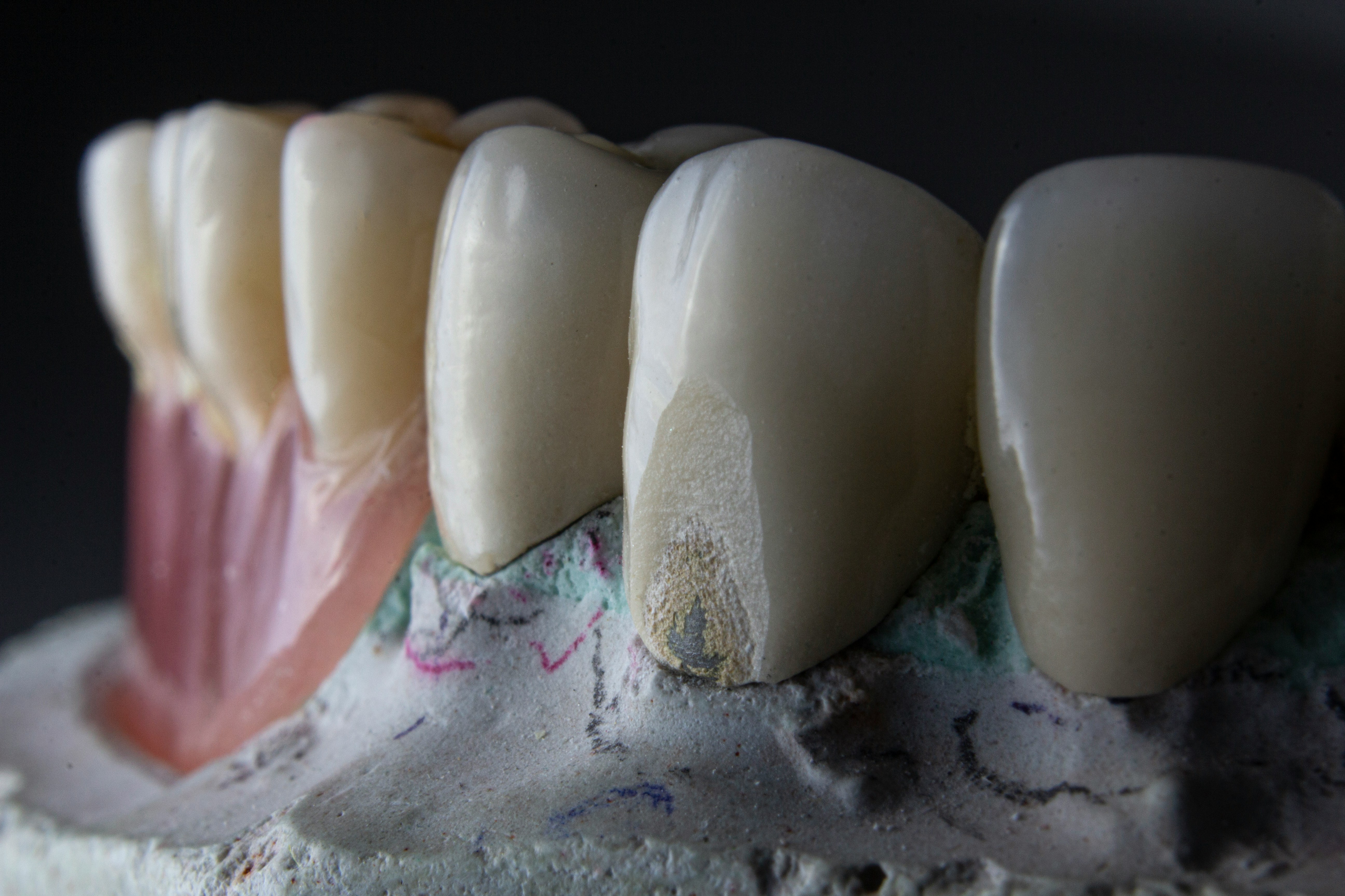 Dental Implants Hasbrouck Heights