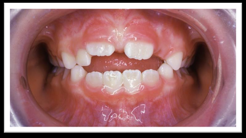 Preventive treatment smile before photo