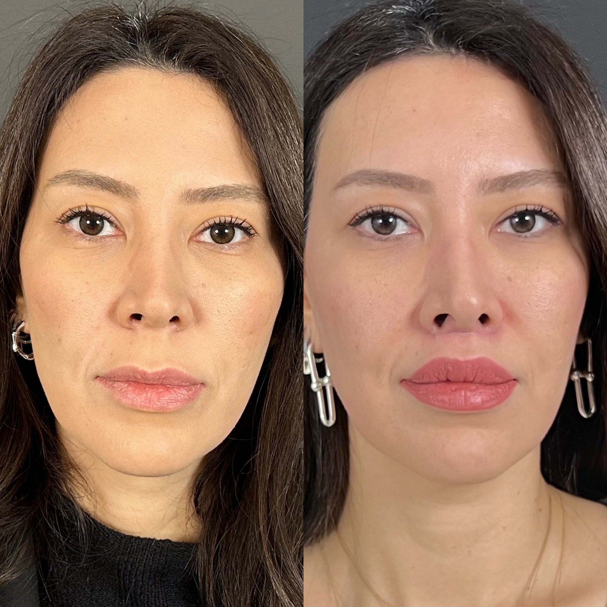 3 weeks lip-lift result before after