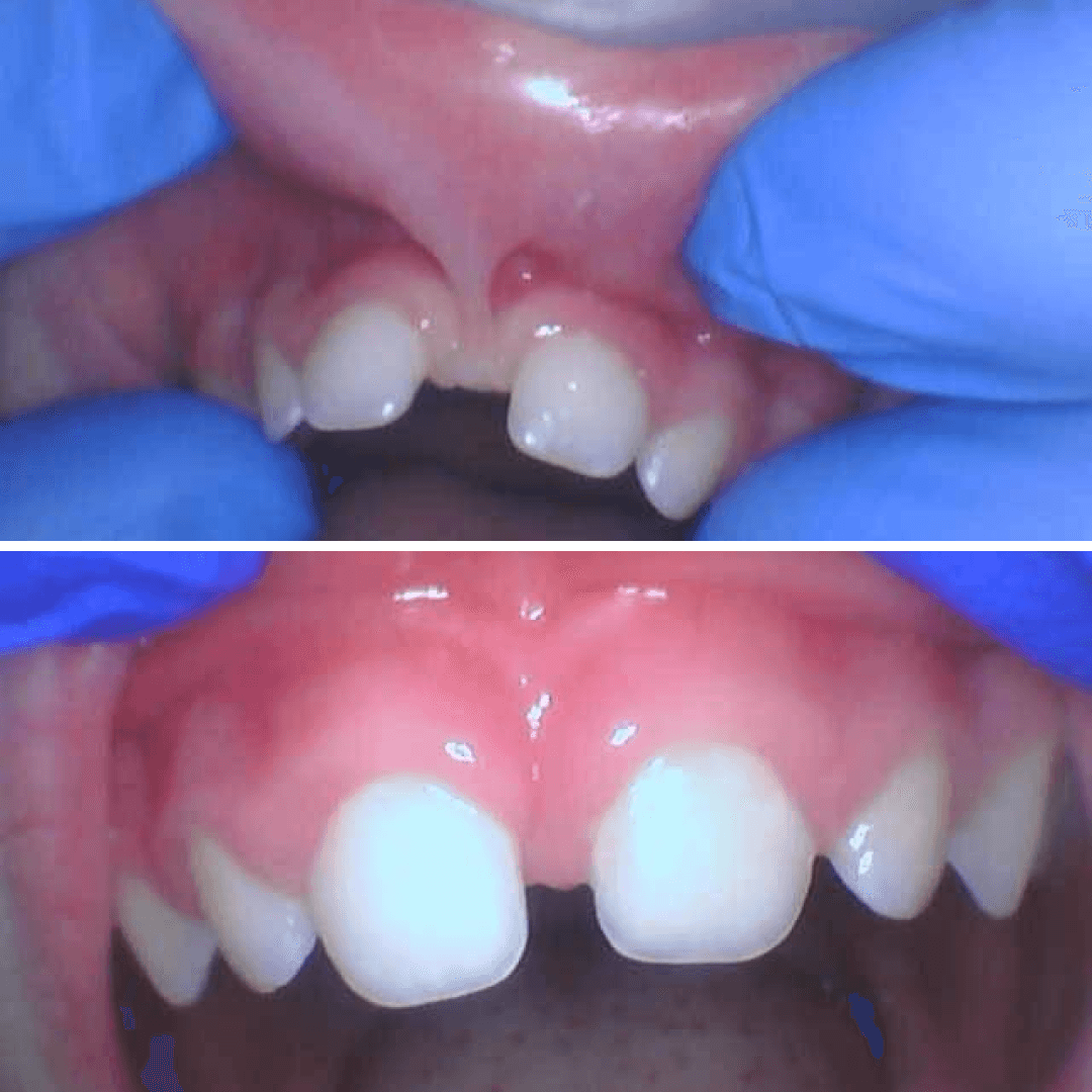 Before and after results of a gentle laser lip-tie release to help with feeding and dental spacing.