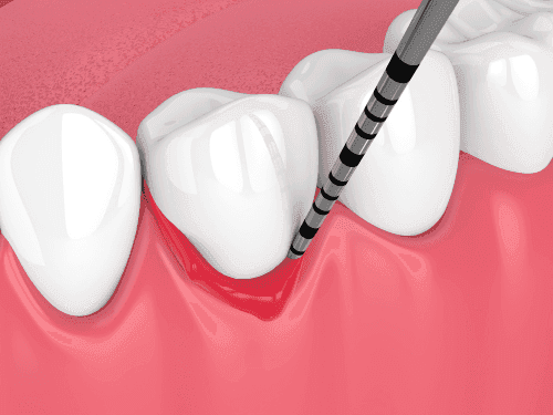Periodontal Disease Treatment in Toronto | Bloor-Yorkville Periodontics