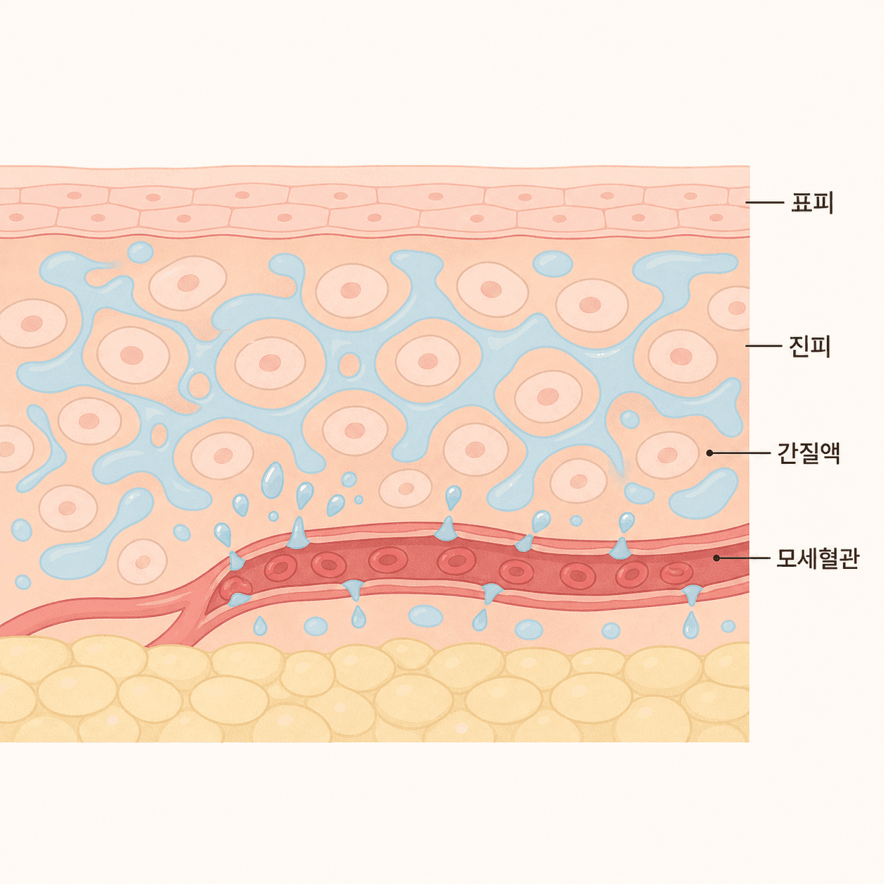 세포 사이 공간에 물이 고이면서 붓기가 생겨요