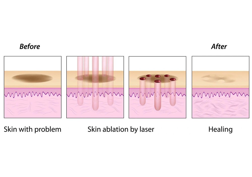 pigmentation laser function process