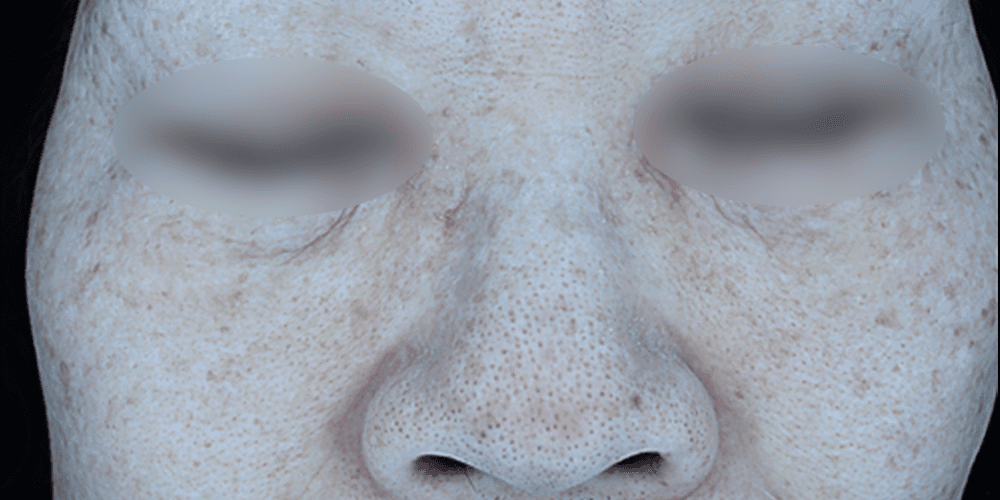 Pigmentation - After
