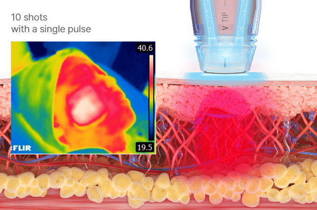 Thermografie der Volnewmer RF-Erwärmung – kontrollierte Tiefenwärme mit 6,78 MHz