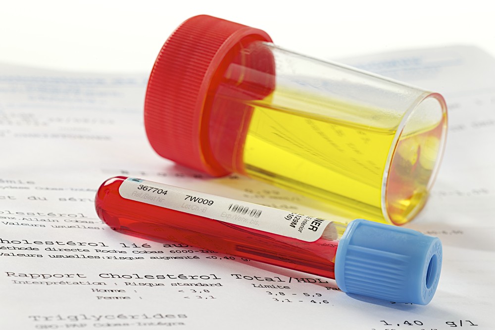 Blood In Urine