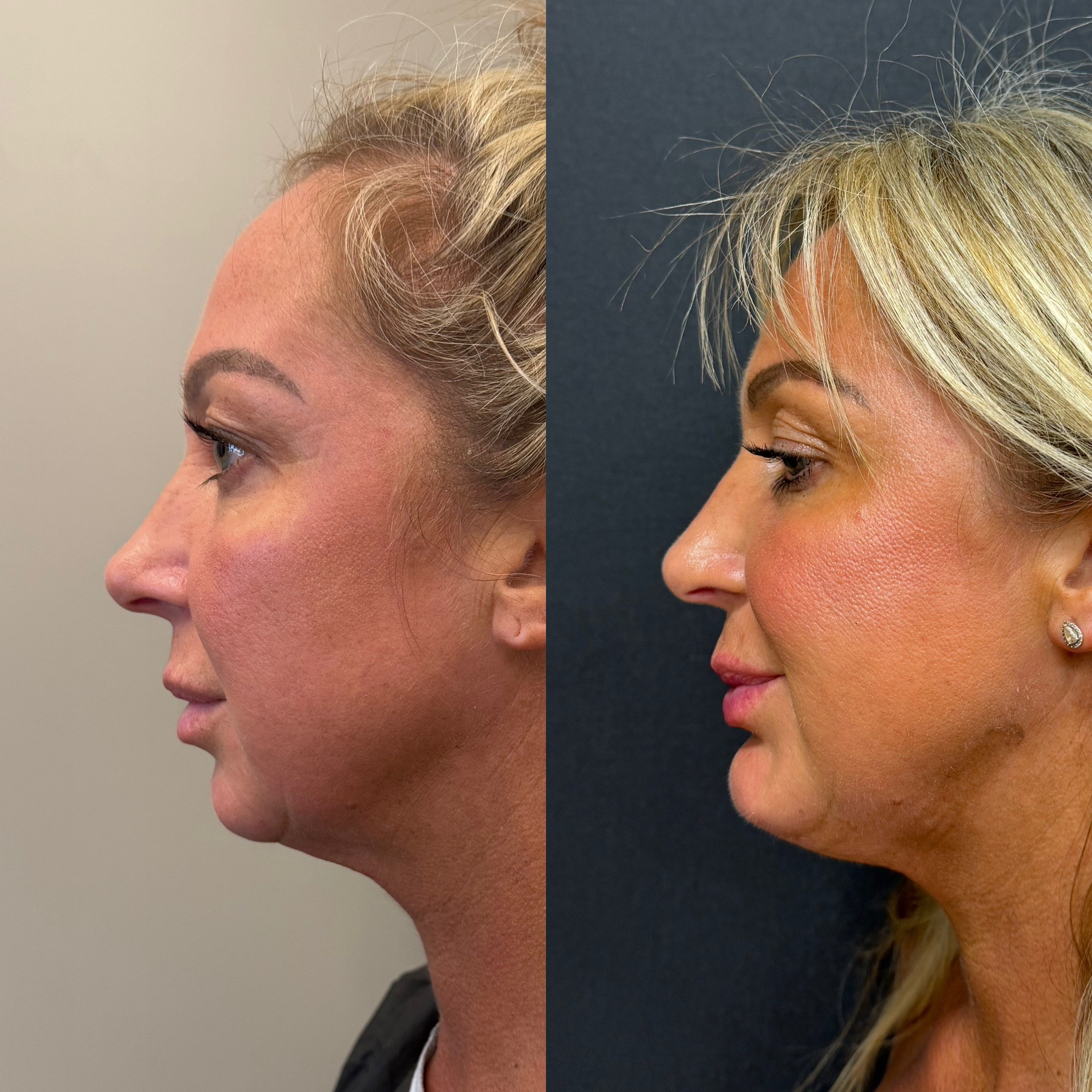 1 week result chin implant before after