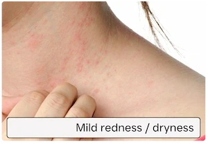 Mild redness / dryness