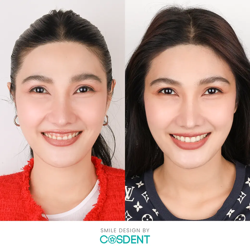 เคสทำวีเนียร์ หมอฝน cosdent smile design