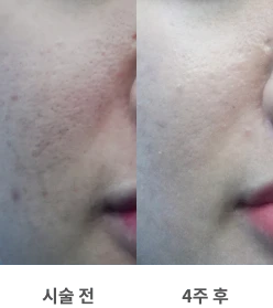 피부_콜라겐물광주사_전후비교_전후비교_르샤인