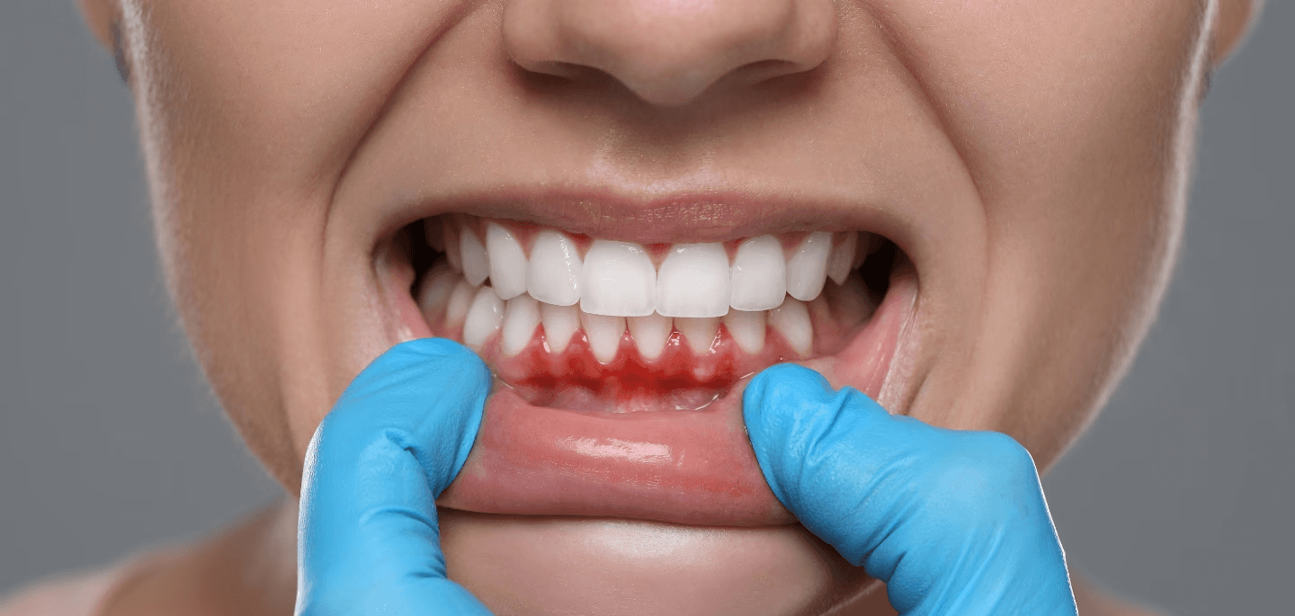 gum disease