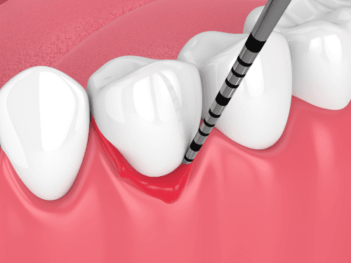 Periodontal Disease Treatment at Sovrle Dental Clinic