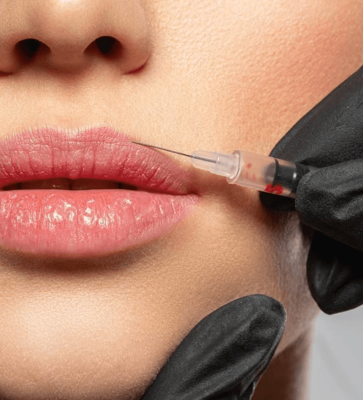 Dermal Fillers Face