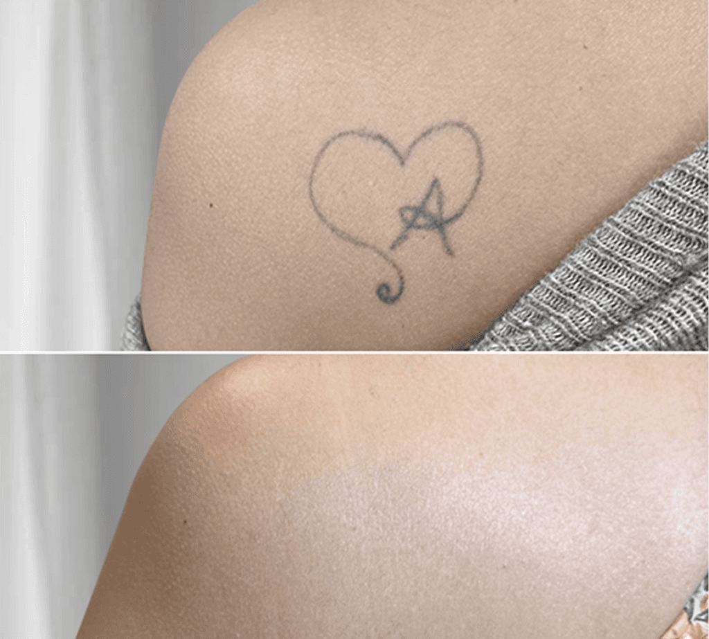 Haarausfall bei Männern und Frauen Schweiz