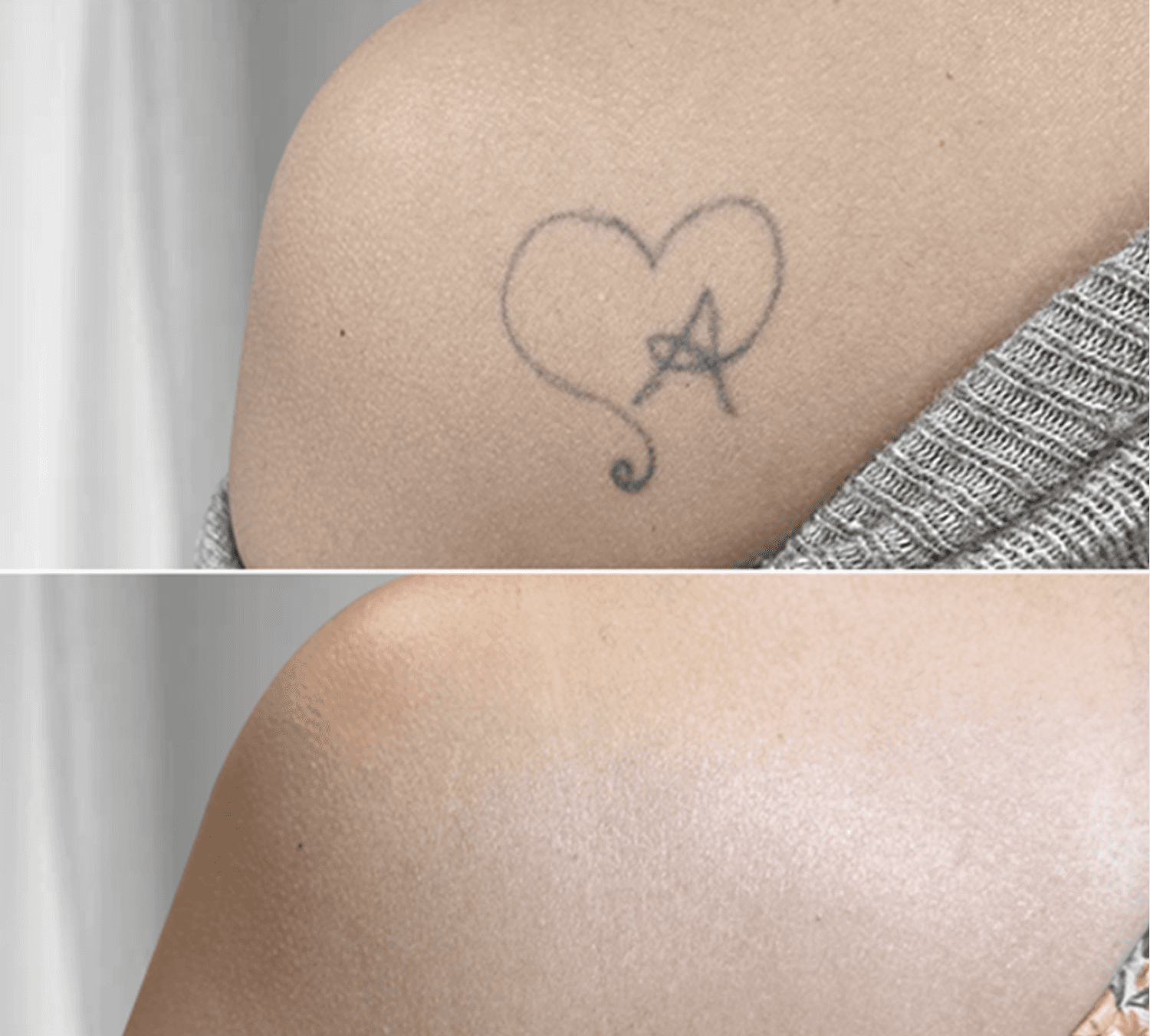 Tattooentfernung Schweiz