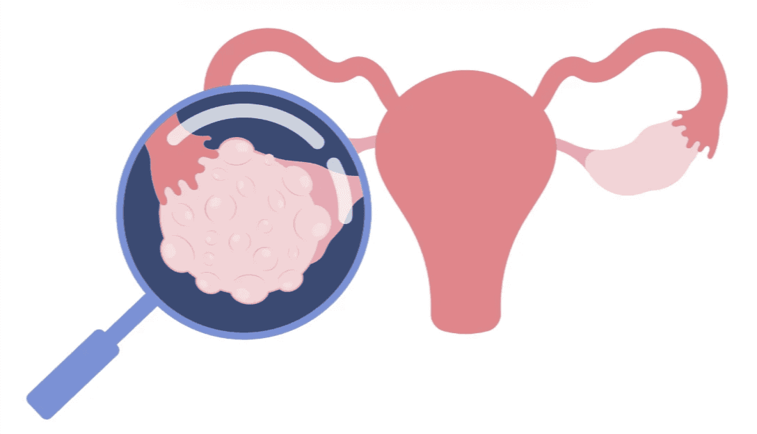 ภาพประกอบรังไข่และมดลูก พร้อมแว่นขยายที่แสดงถุงไข่หลายใบในรังไข่ สื่อถึงภาวะ PCOS หรือถุงไข่รังไข่หลายใบ