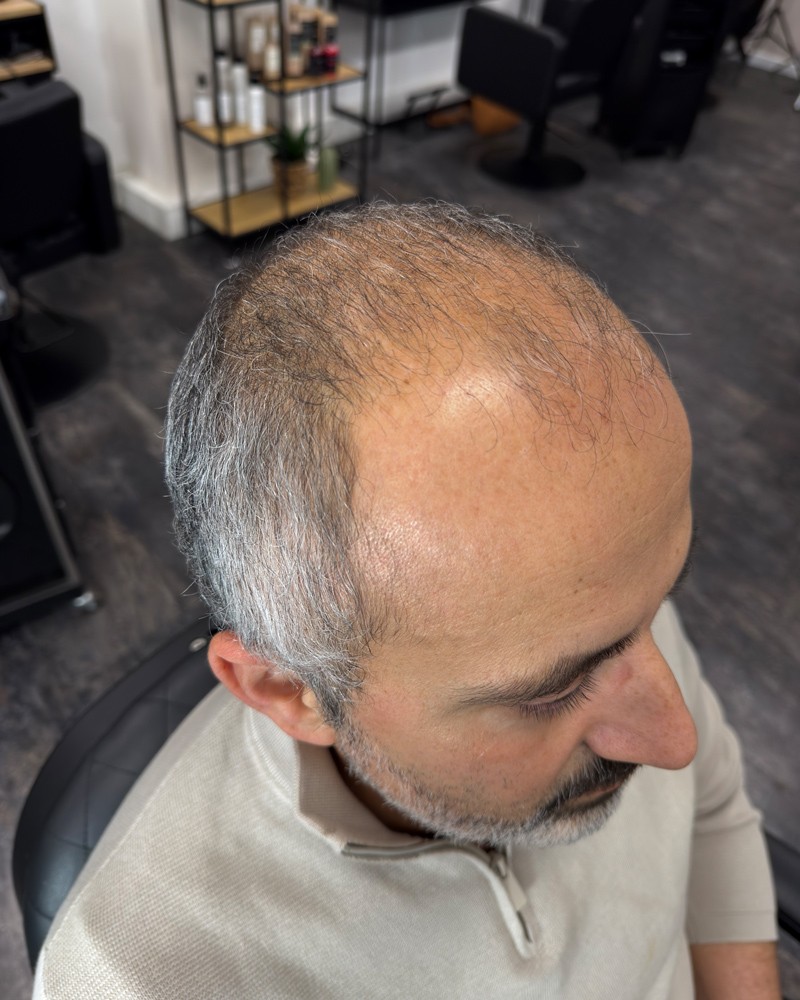 Cortese Haarsysteme - Vorher-Ansicht 4