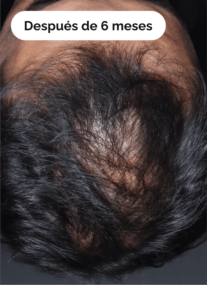 alopecia androgénica