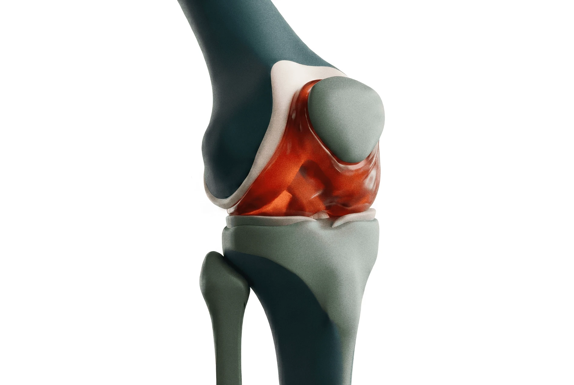 Adult Knee Synovitis