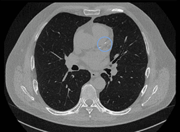 Calcium Score Heart CT Imaging