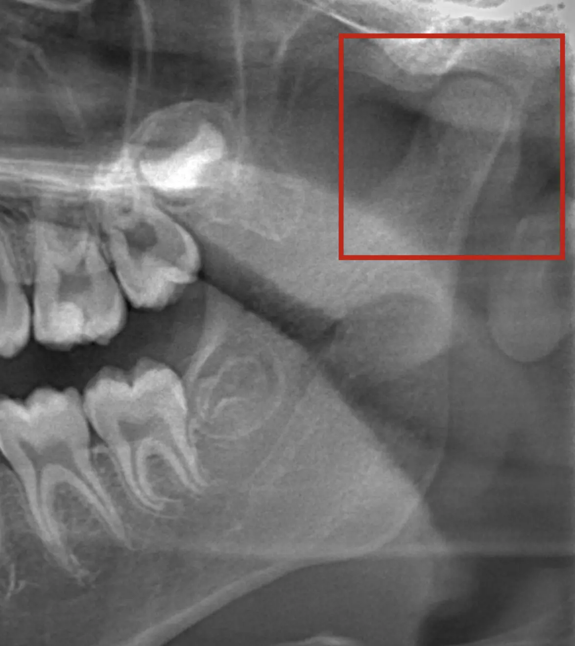 Healthy TMJ
