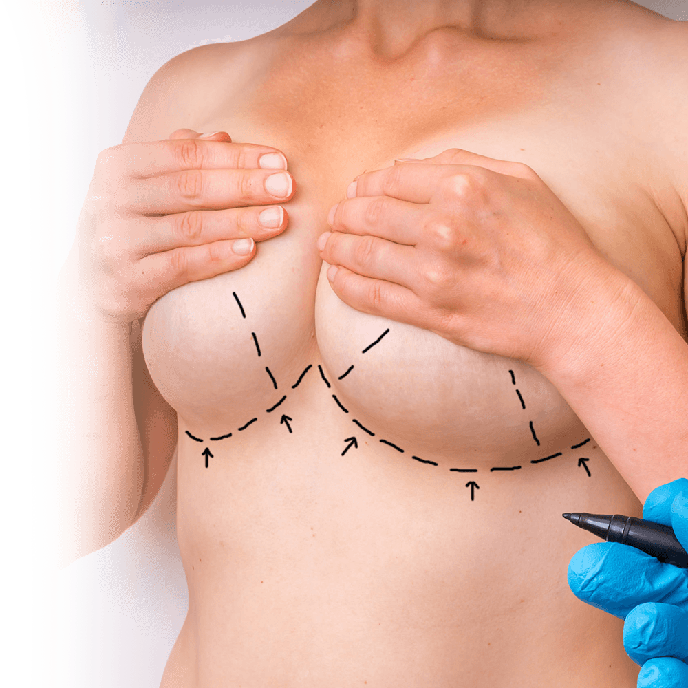 scar placement of breast reduction surgery