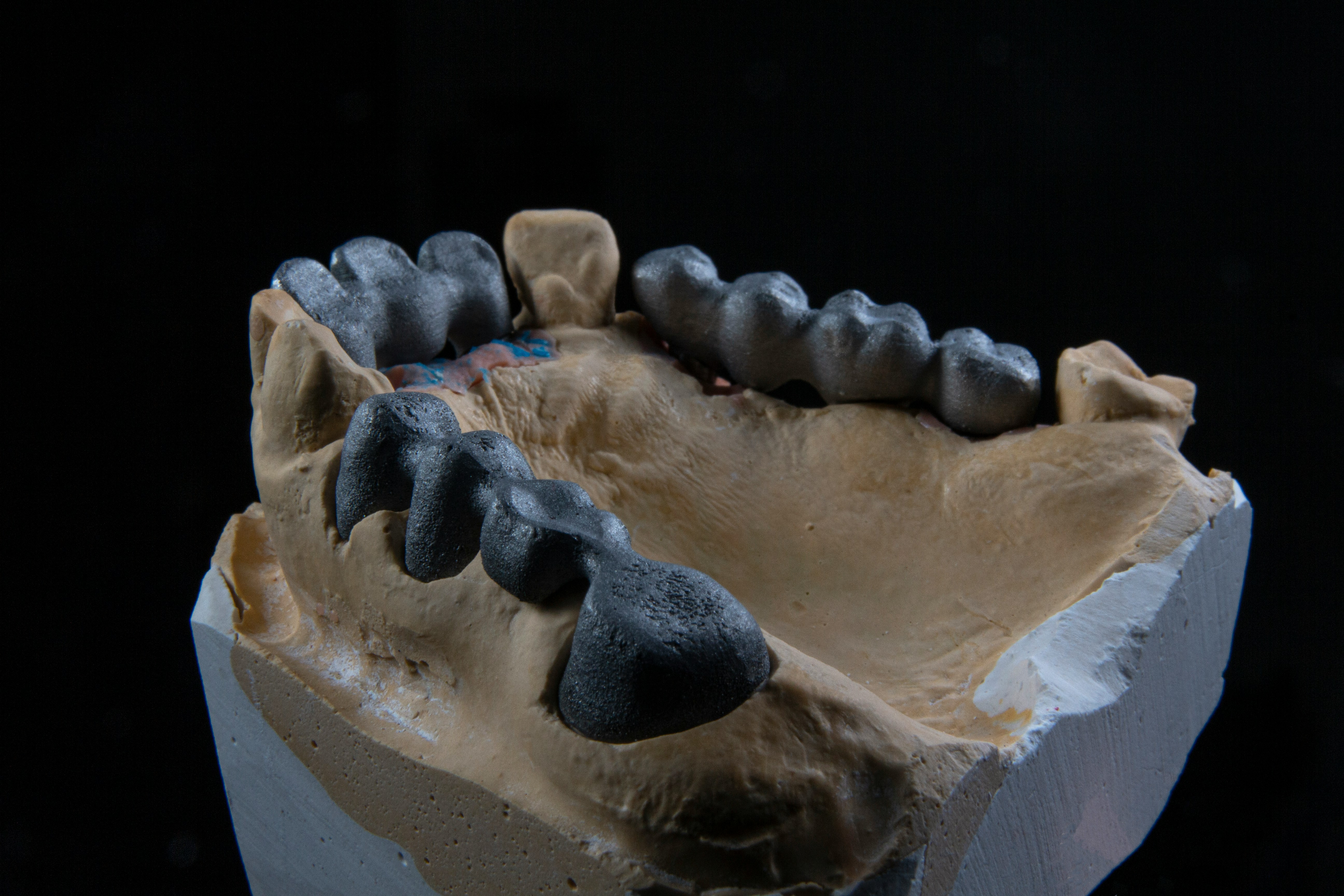 Dental Implants Elmwood Park