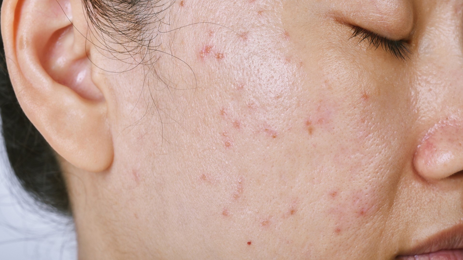 Acne scar removal treatments in Singapore.