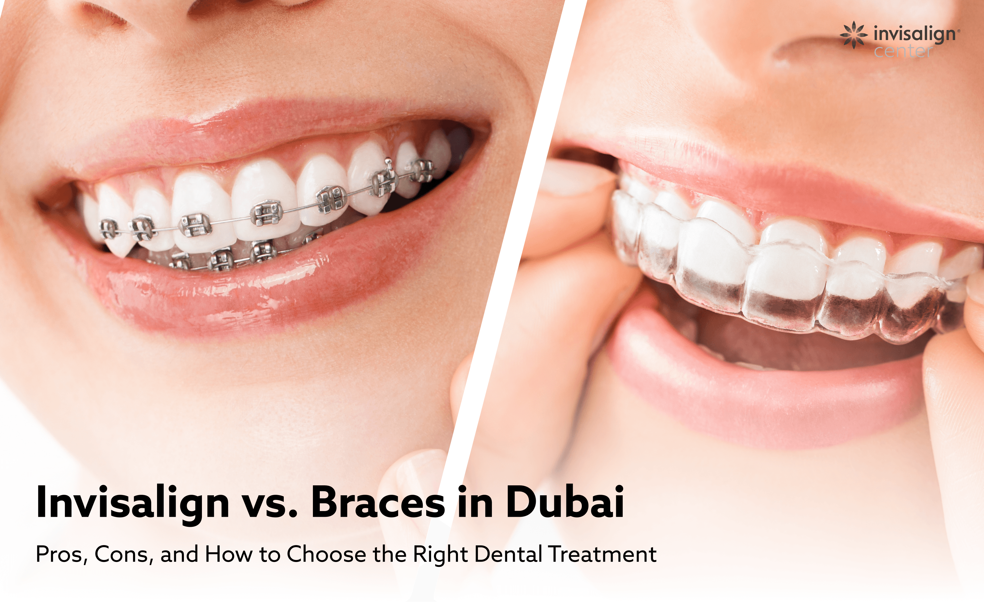 invisalign vs braces in dubai which is right for you