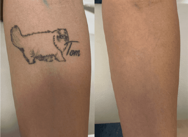 Imagem de antes e depois da remoção de tatuagem