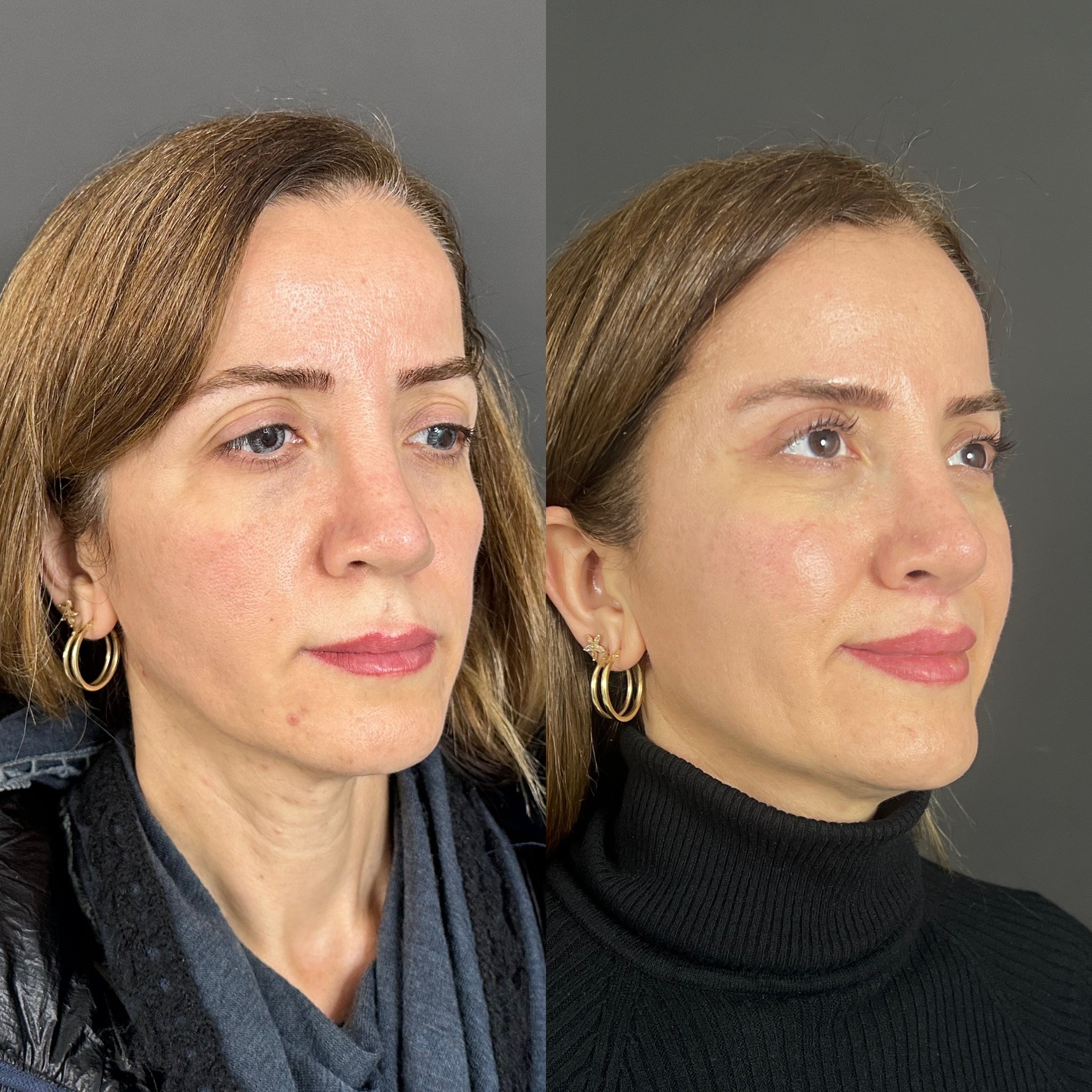 temporal lift and upper blepharoplasty before after oblique view