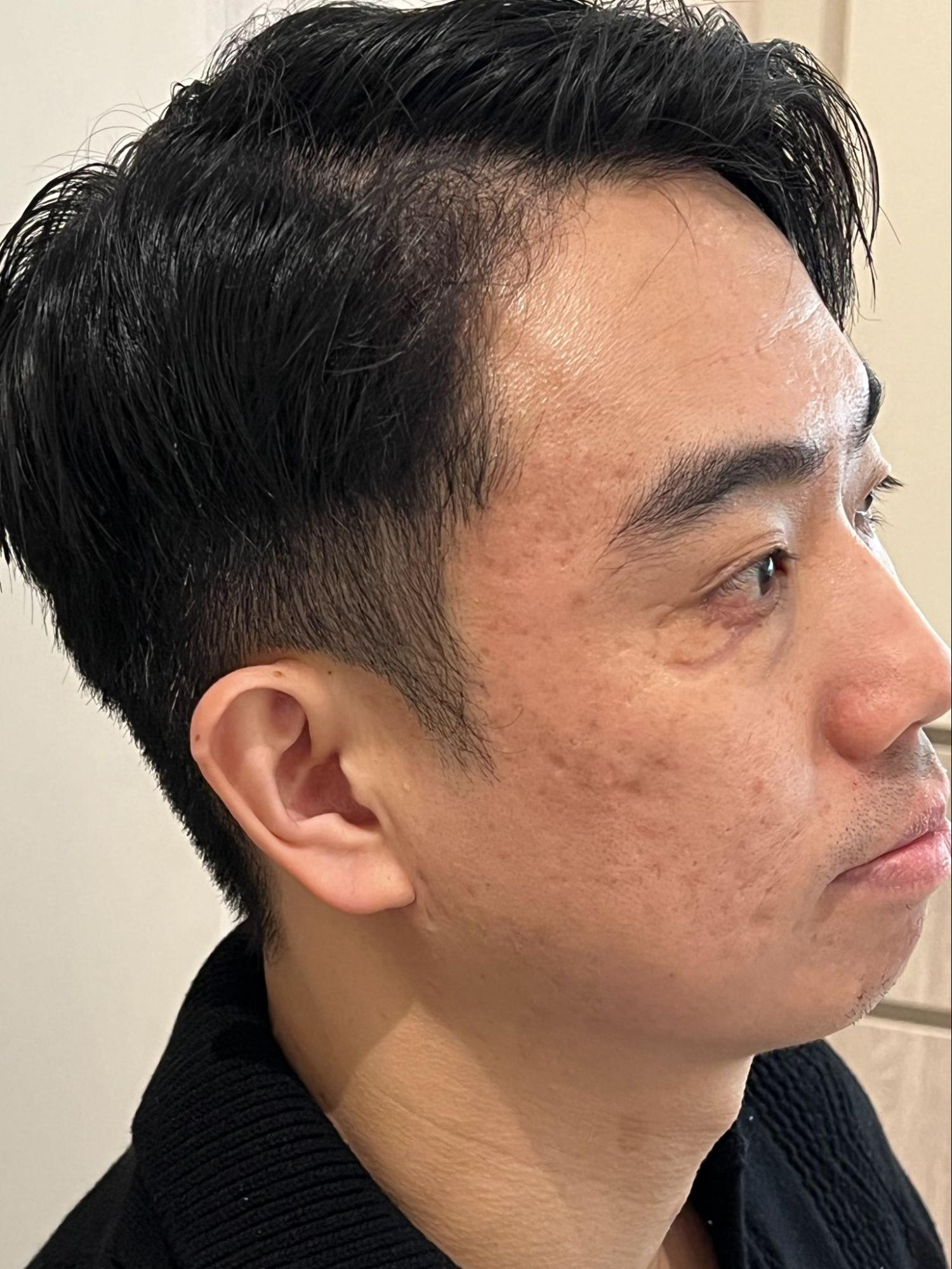 Ultherapy vs Thermage blog: woman holding her chin