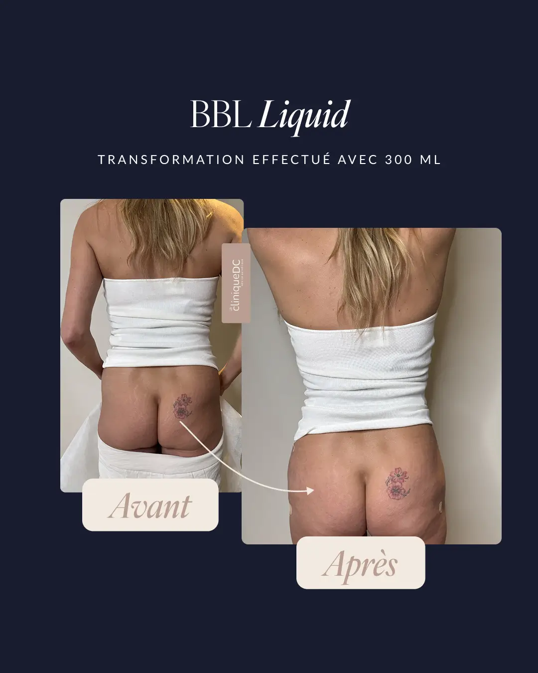 avant-après epilation laser visage dame agée