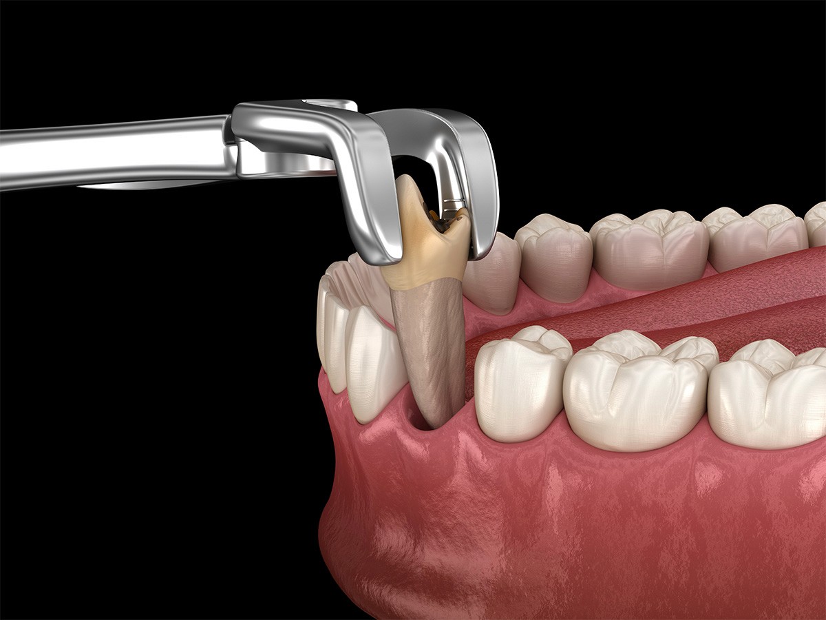 veneers
