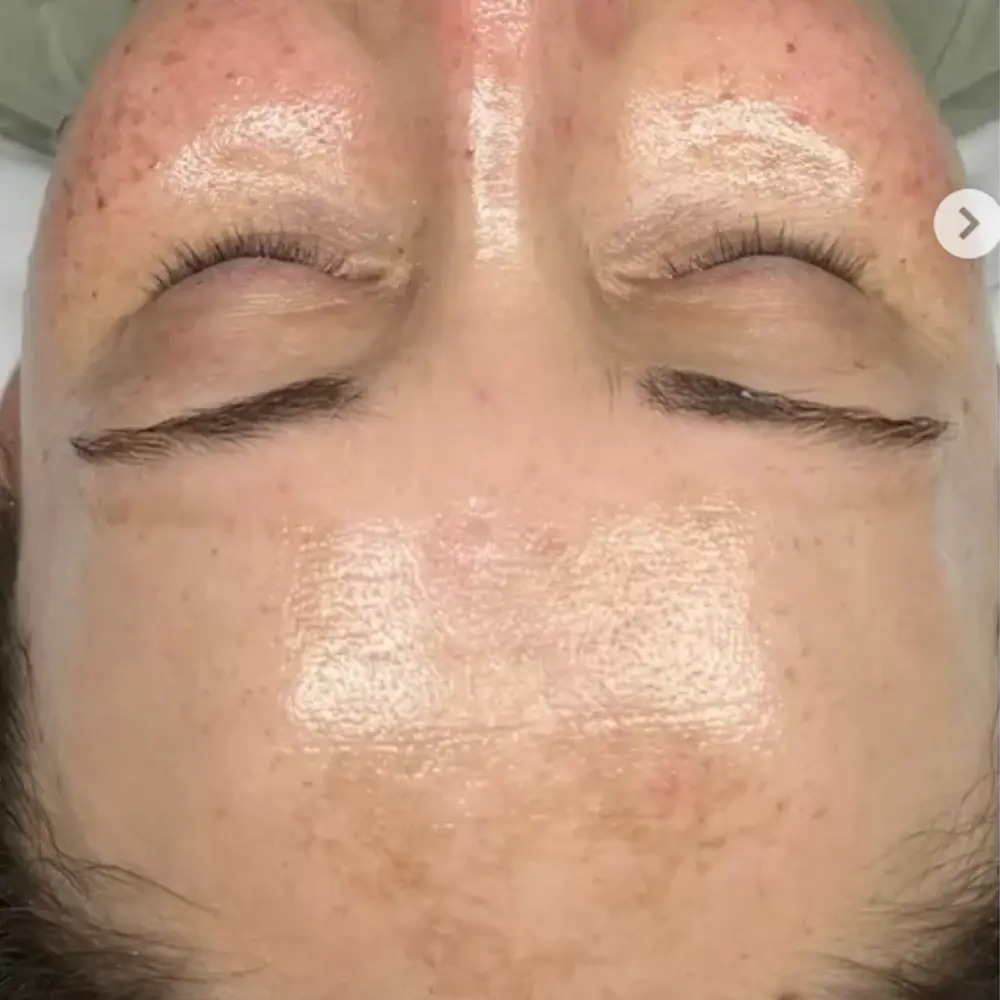 After hydrating brightening facial at The Vancouver Aesthetician — melasma visibly faded, dullness resolved and skin noticeably glowing and radiant